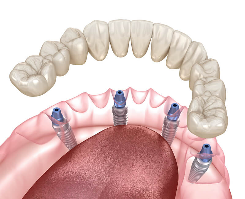 Types Of Partial Dentures