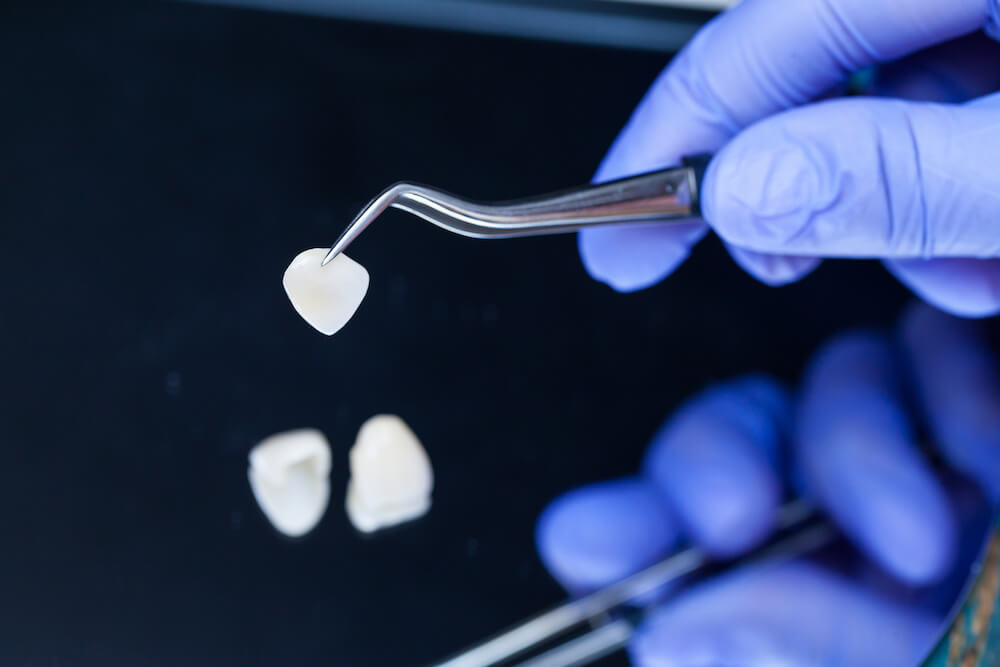 Can You Still Get Cavities With Veneers? Yes – Here’s Everything You Need To Know