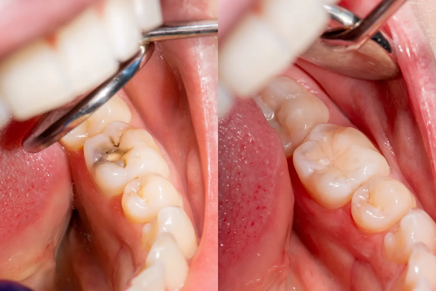 Are Dental Fillings Painful?