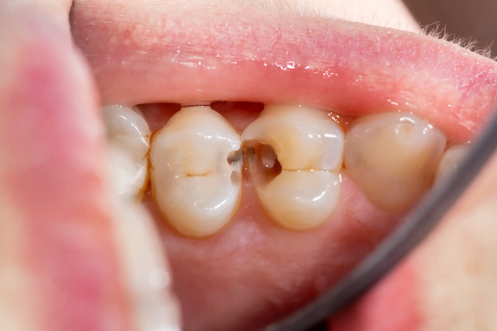 Dental Sealants: How They Protect Your Child’s Teeth from Cavities