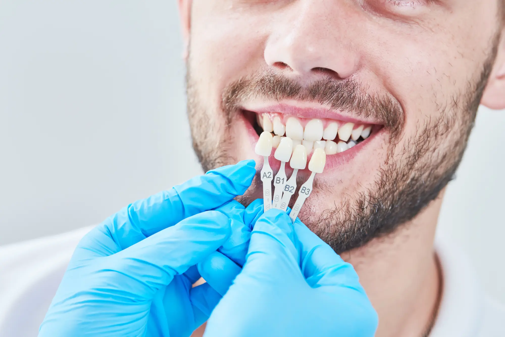 How to Take Care of Veneers