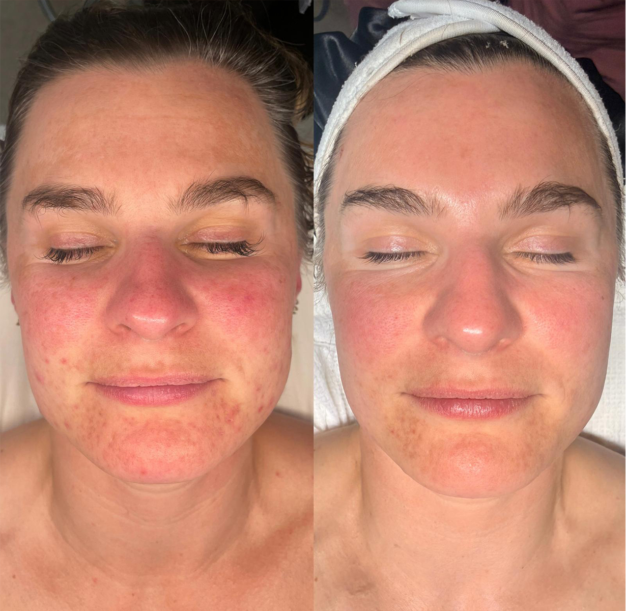 Before and after skin result 2