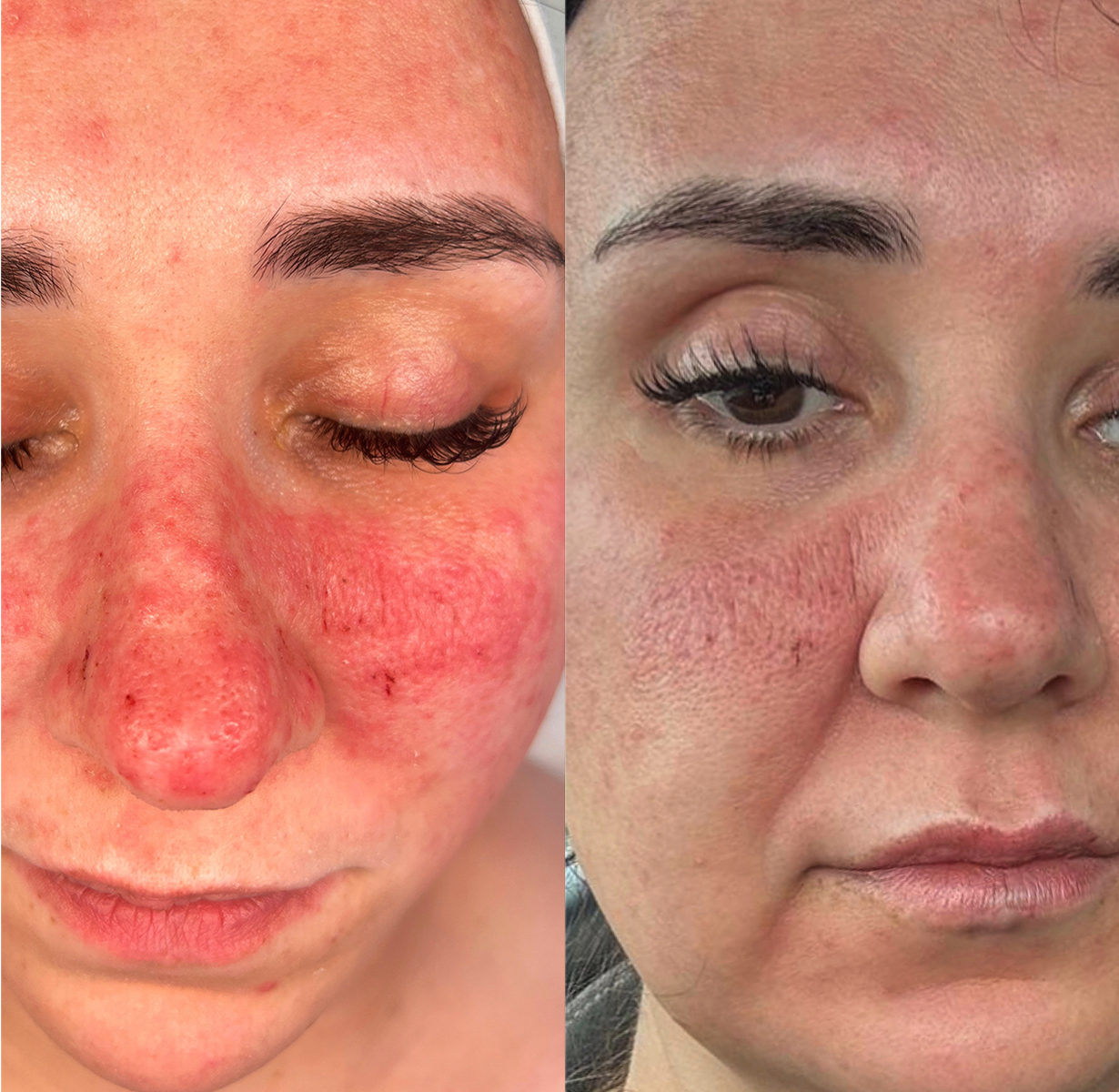 Before and after skin result 3