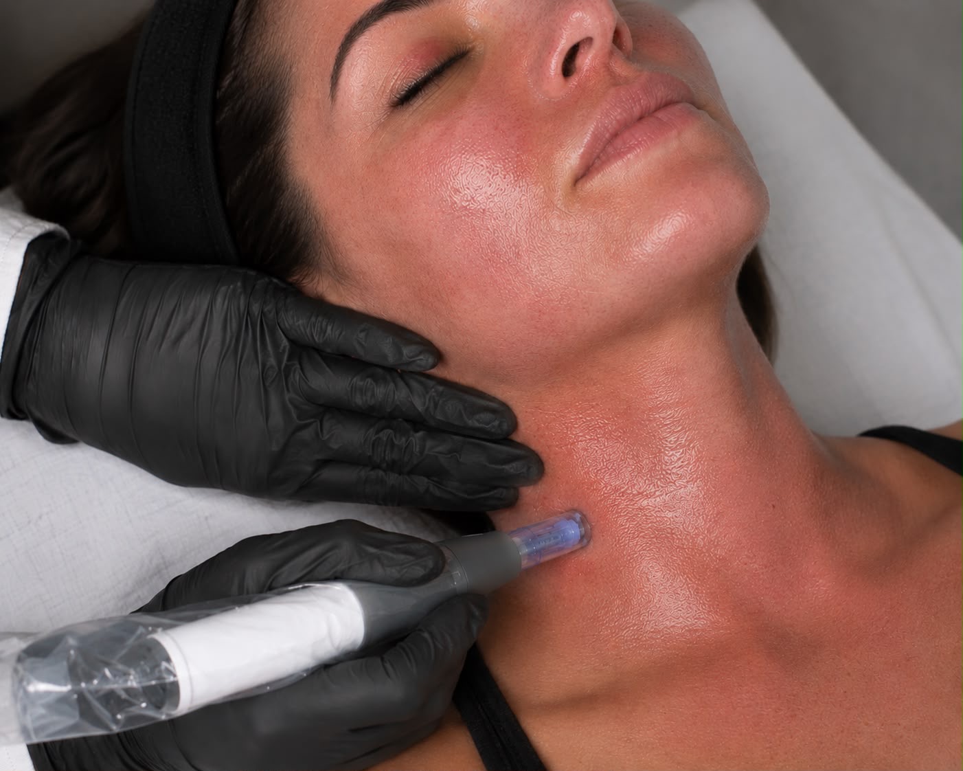 RF Skin Tightening Microneedling
