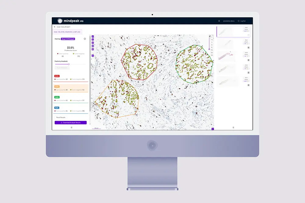 Computer monitor displaying Mindpeak IMS software analyzing Ki67 stained tumor sample with proliferation score and tumor positivity statistics.