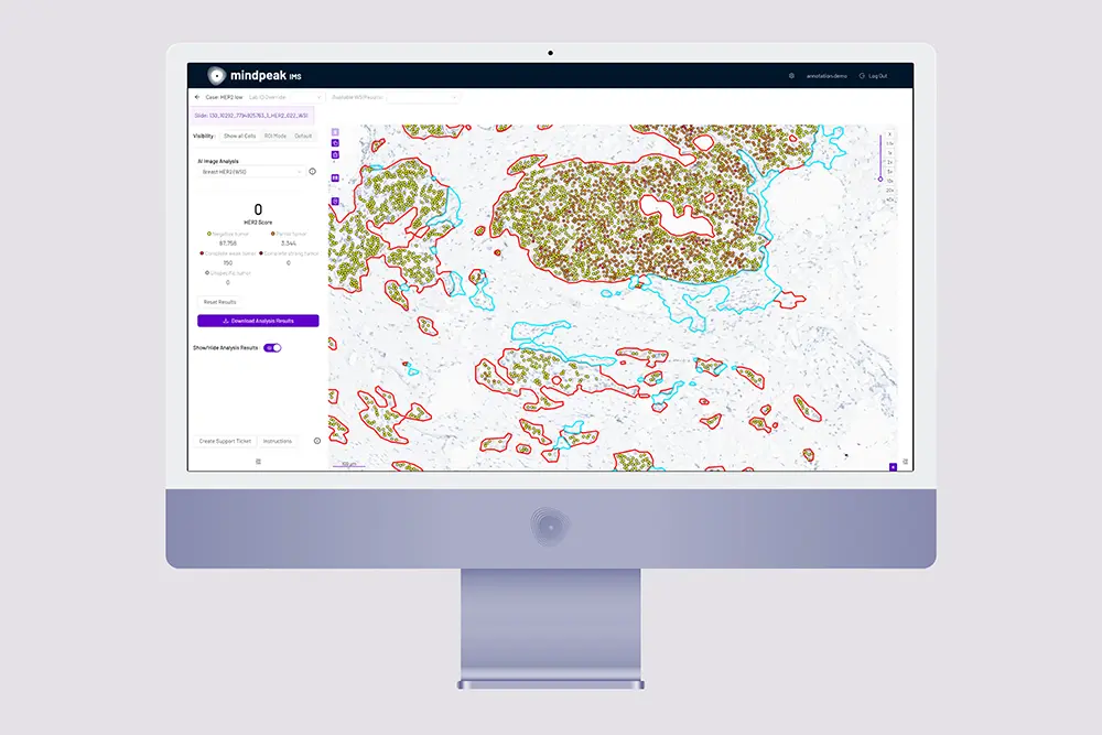 Computer monitor displaying Mindpeak IMS software with annotated tissue analysis and HER2 scoring results.