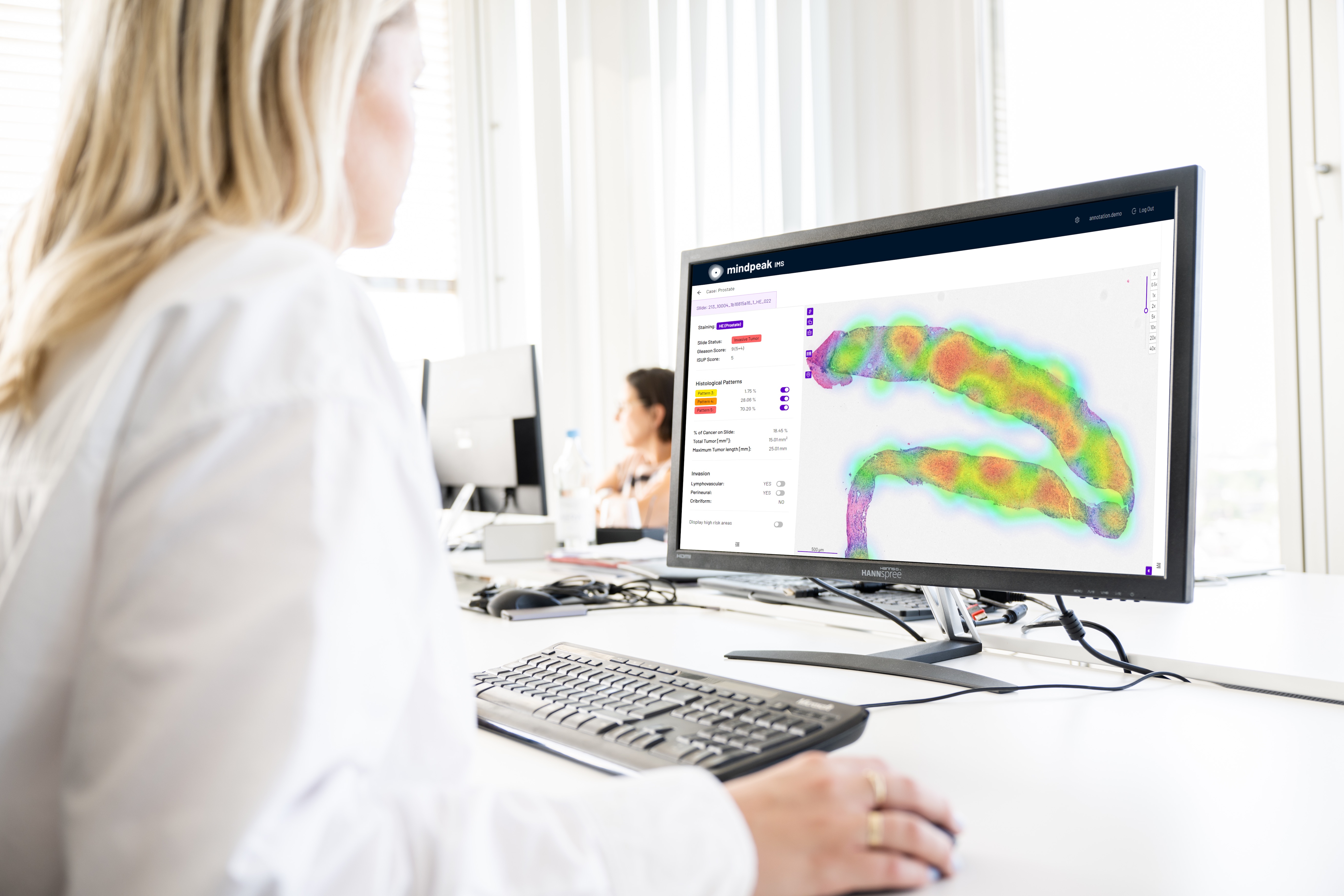 Mindpeak unveiled a new product to empower pathologists in detecting and grading prostate cancer.