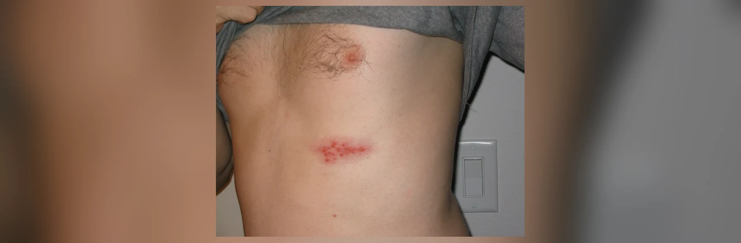 Fotografia kliniczna skóry dolnej części klatki piersiowej u osoby o jasnym fototypie: skupisko drobnych, zgrupowanych pęcherzyków na zaczerwienionym podłożu, ułożone jednostronnie po jednej stronie tułowia, obraz typowy dla wczesnej fazy półpaśca.