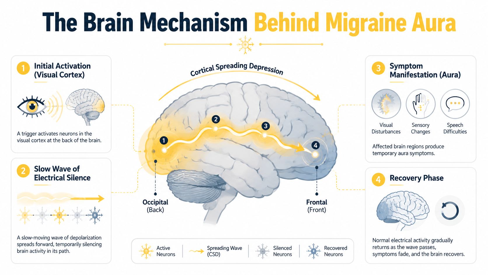 A diagram illustrating the four stages of cortical spreading depression as the brain mechanism behind migraine aura.