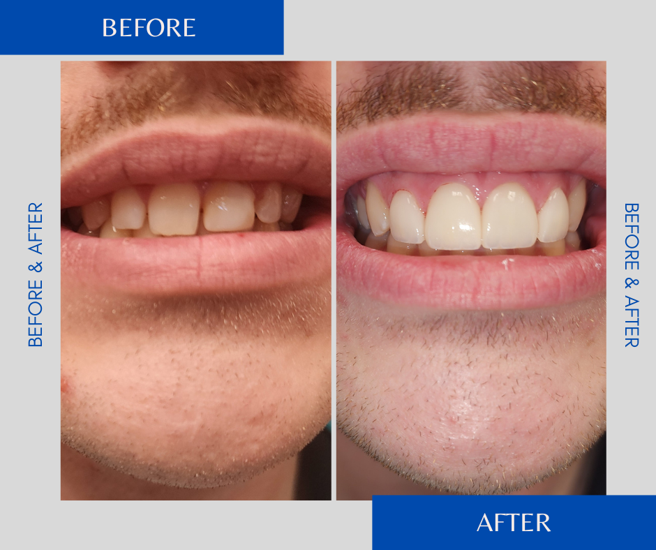 Before and after of dental work