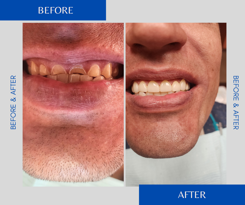 Before and after of dental work