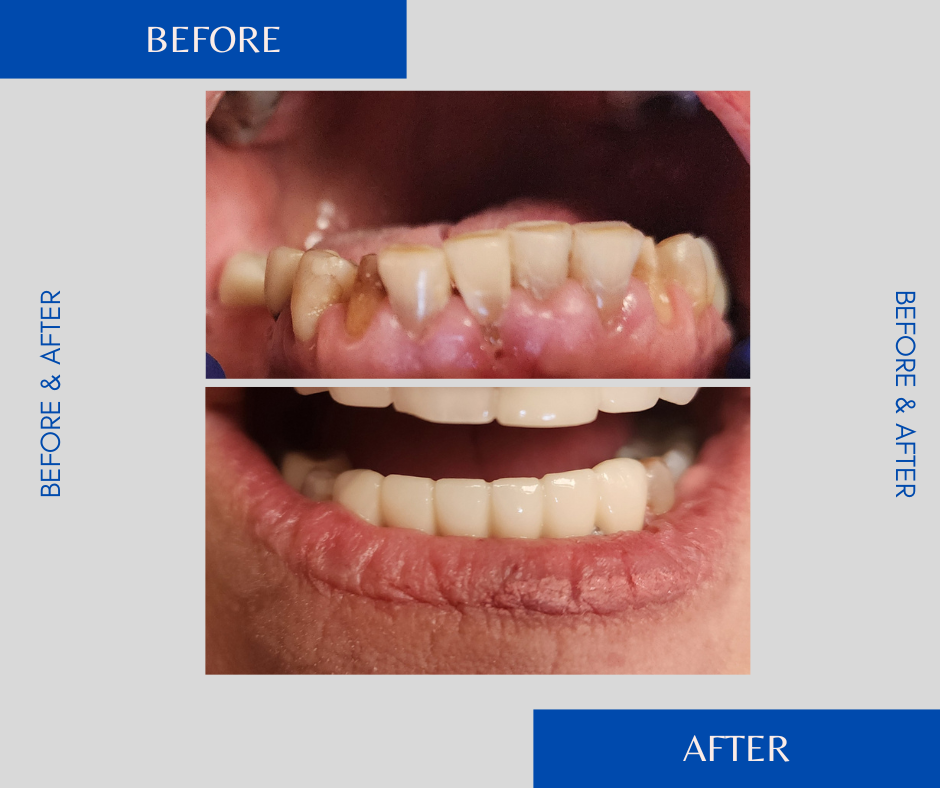 Before and after of dental work