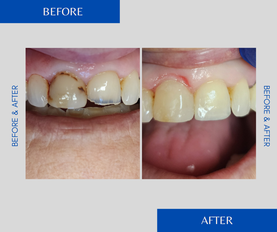 Before and after of dental work