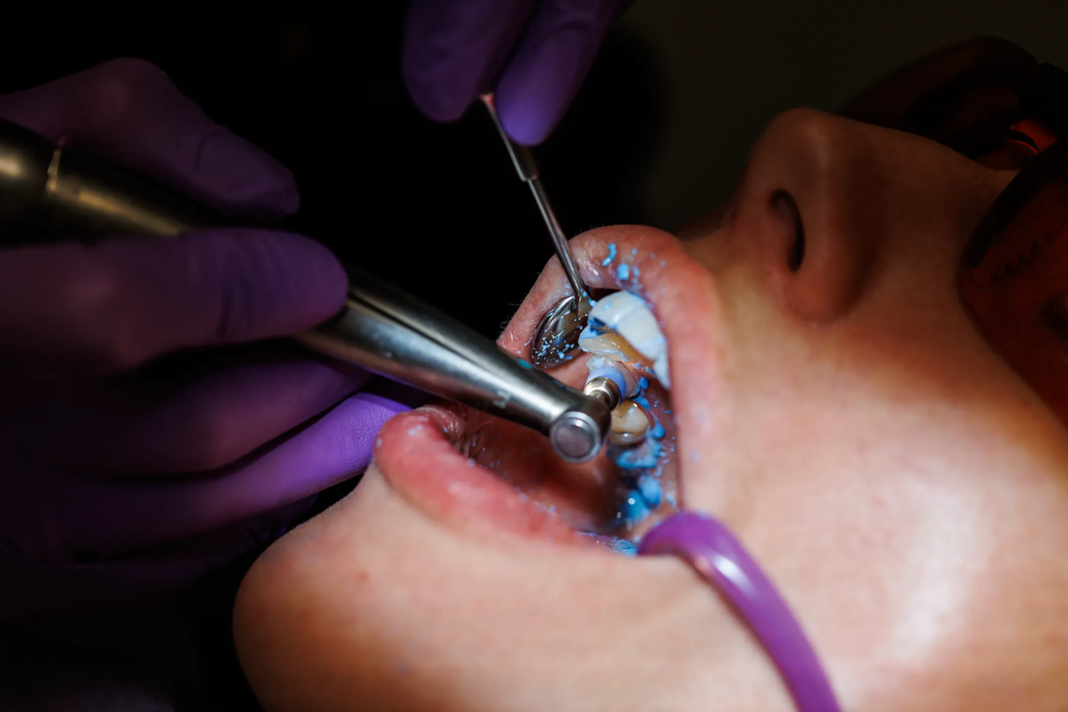 Fluoride Treatment