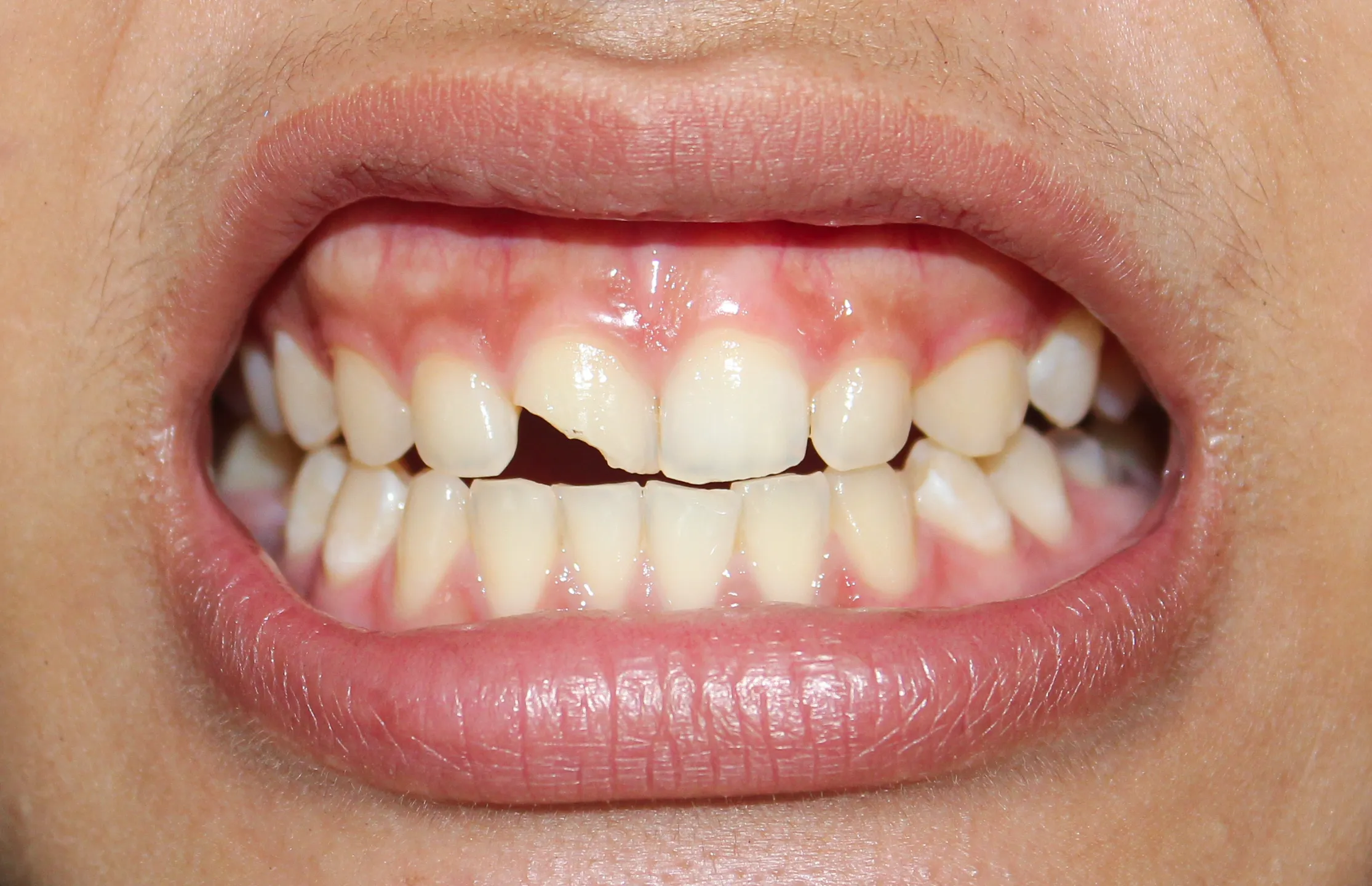 Cracked Tooth Repair