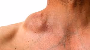 Everything You Need to Know About Non-Hodgkin Lymphoma