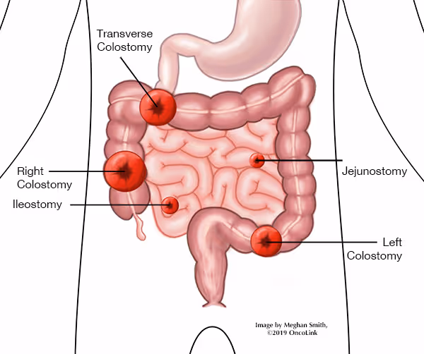 Ileostomy: What Is It, Types, Bags, Surgery & Complications