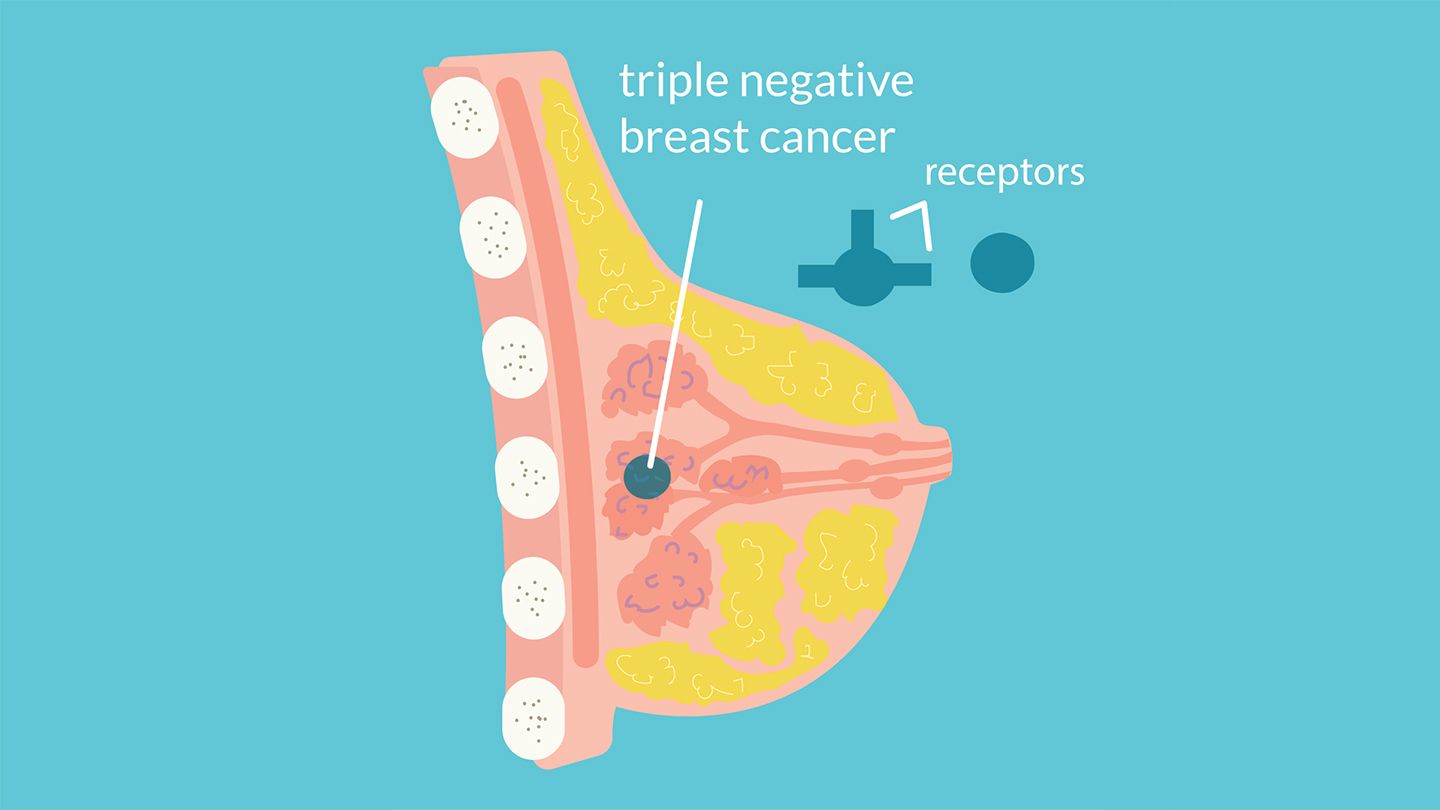 Triple-Negative Breast Cancer: All You Need to Know