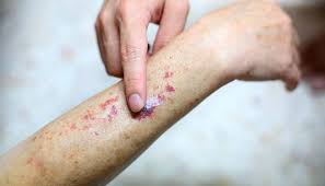 Leukemia Symptoms and Treatments in Turkey