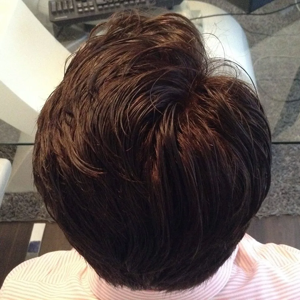 Risultato trapianto capelli con copertura densa su vertex e nuca