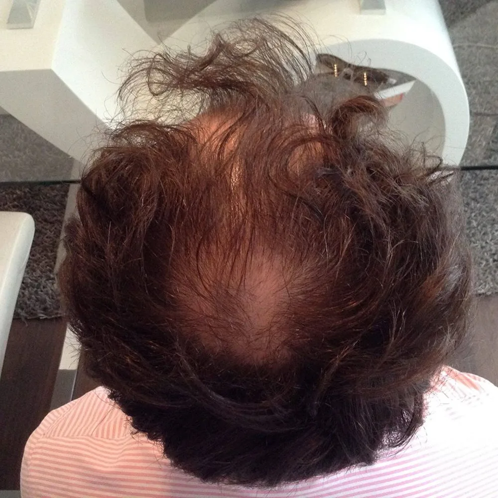 Calvizie avanzata al vertice prima del trapianto capelli