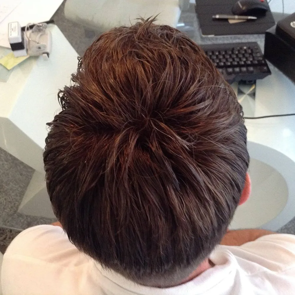 Risultato trapianto capelli vertice con densità uniforme