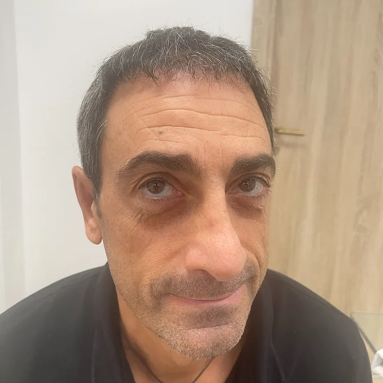 Paziente dopo trapianto capelli con ricrescita visibile