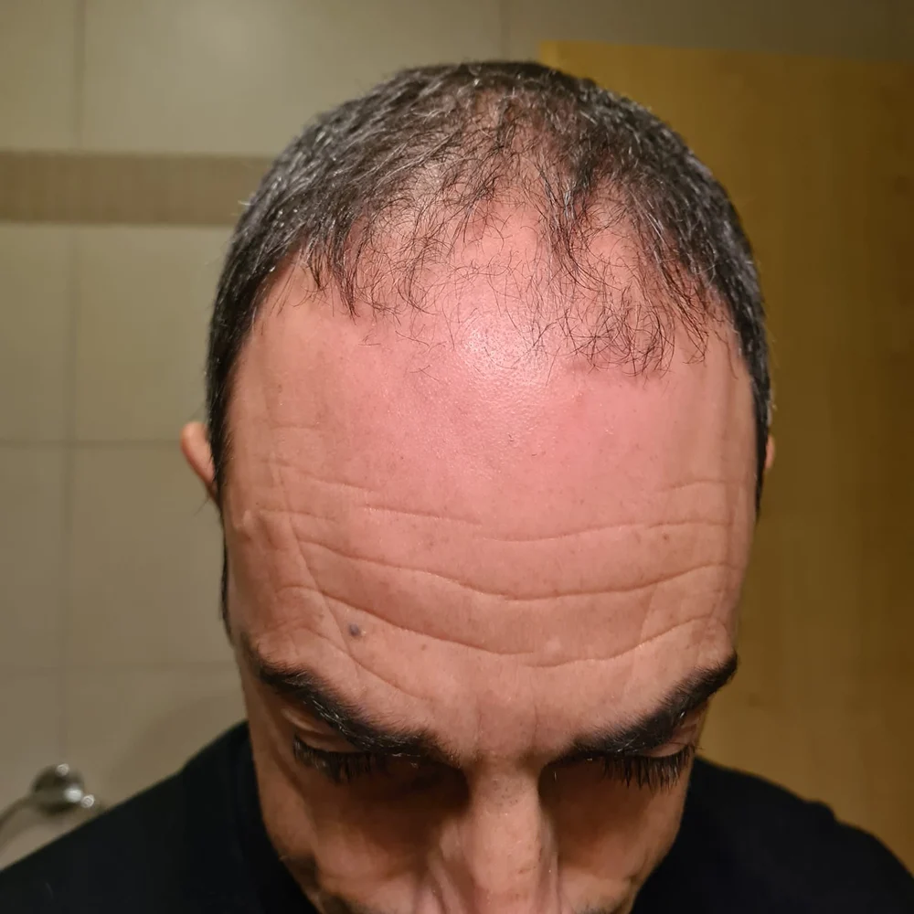 Calvizie avanzata zona frontale e vertex prima del trapianto