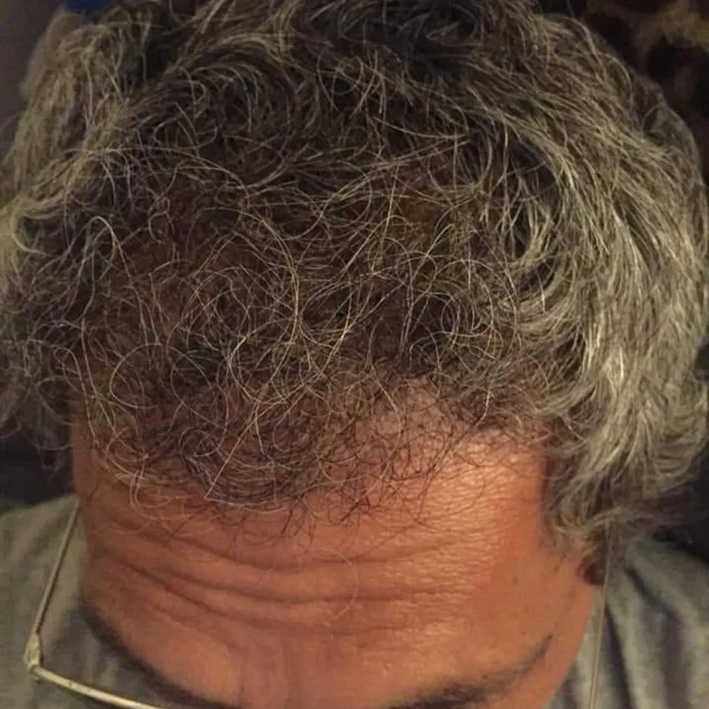 Risultato trapianto capelli su uomo di mezza età