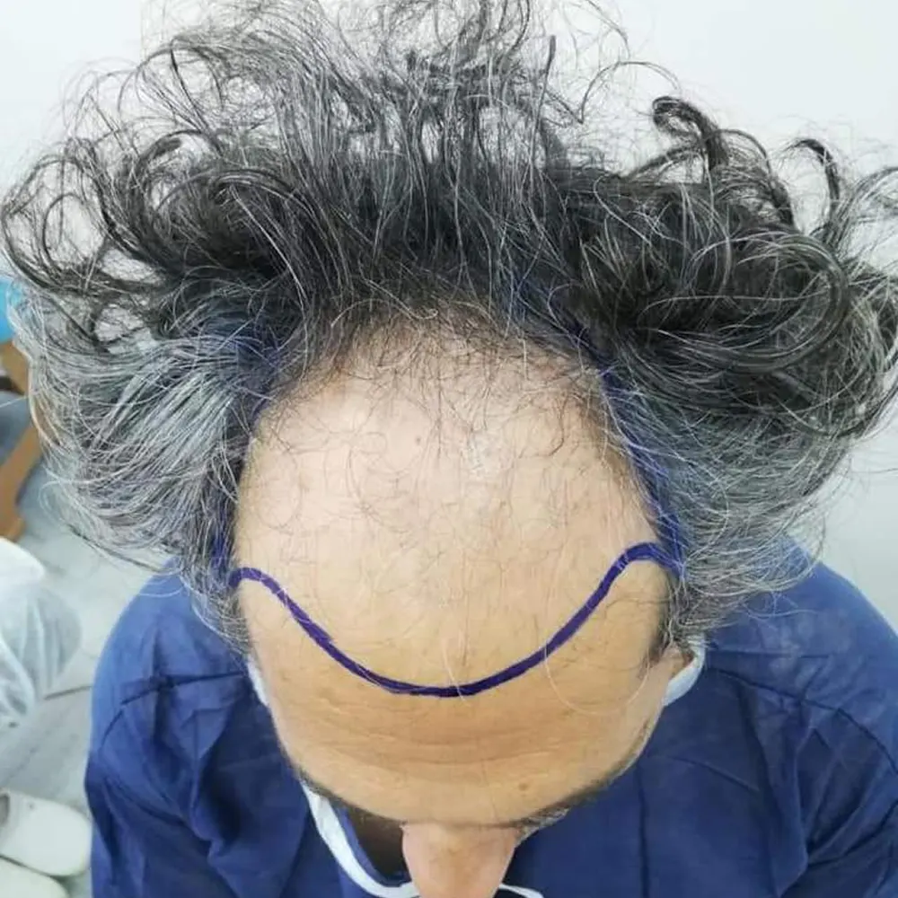 Calvizie frontale avanzata prima del trapianto