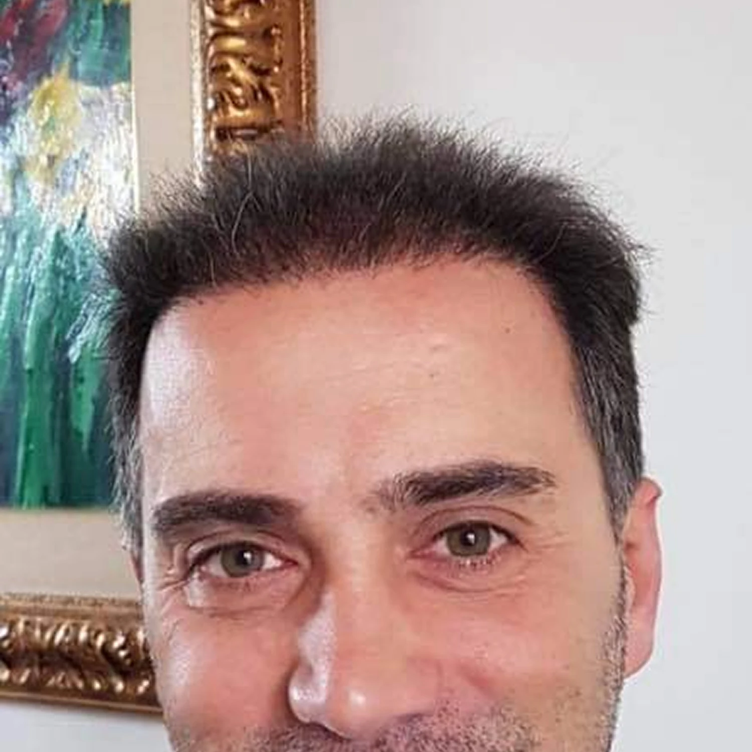 Risultato trapianto capelli su uomo di mezza età