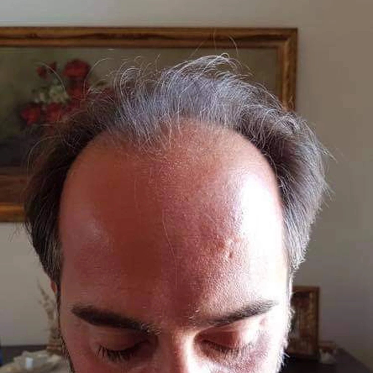 Calvizie frontale avanzata prima del trapianto