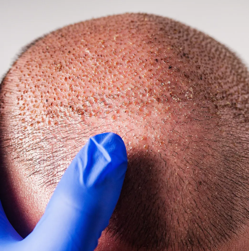 Hall della clinica Estepalace Istanbul per trapianto capelli in Turchia