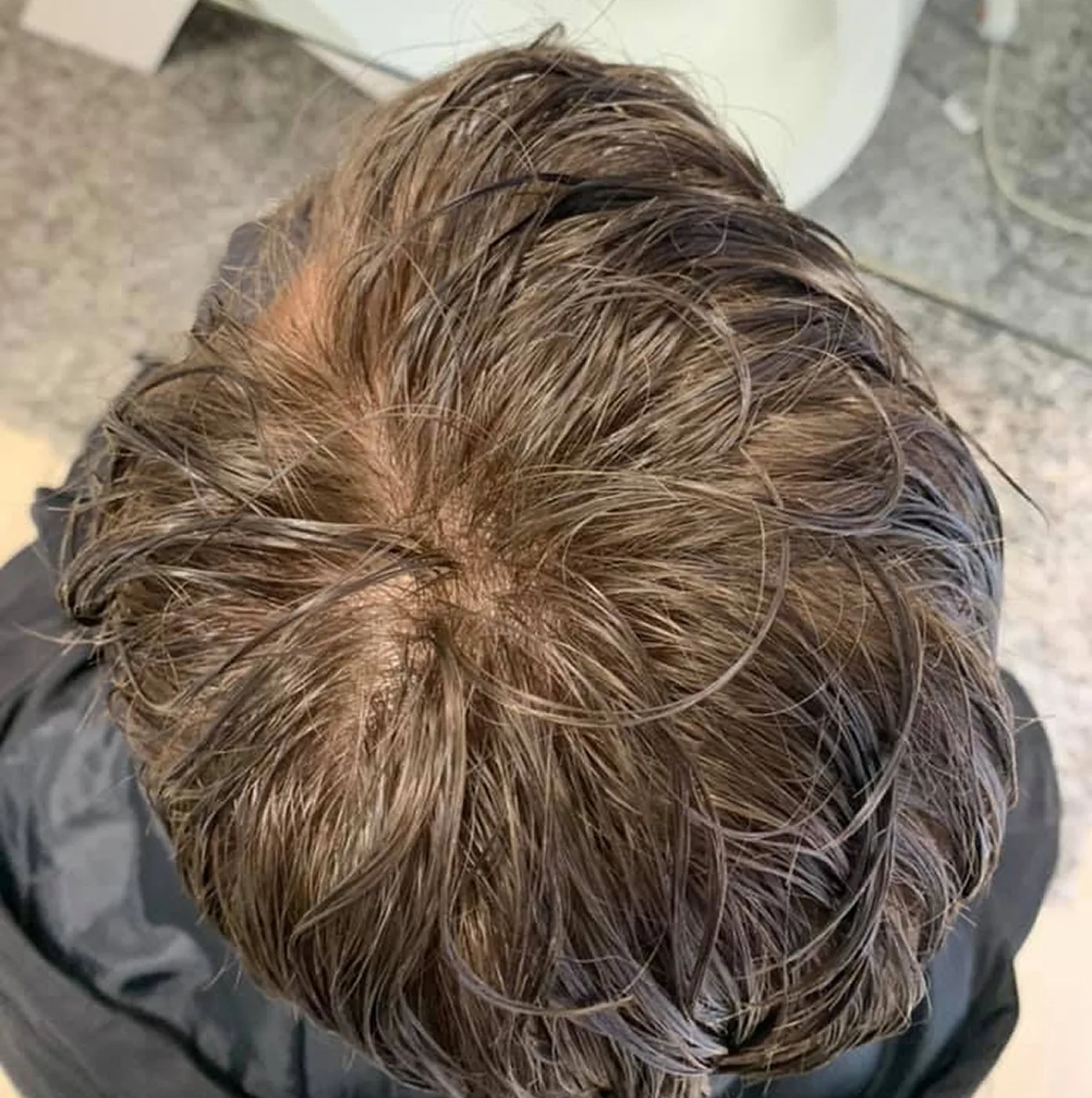 Risultato trapianto capelli su paziente con ricrescita completa