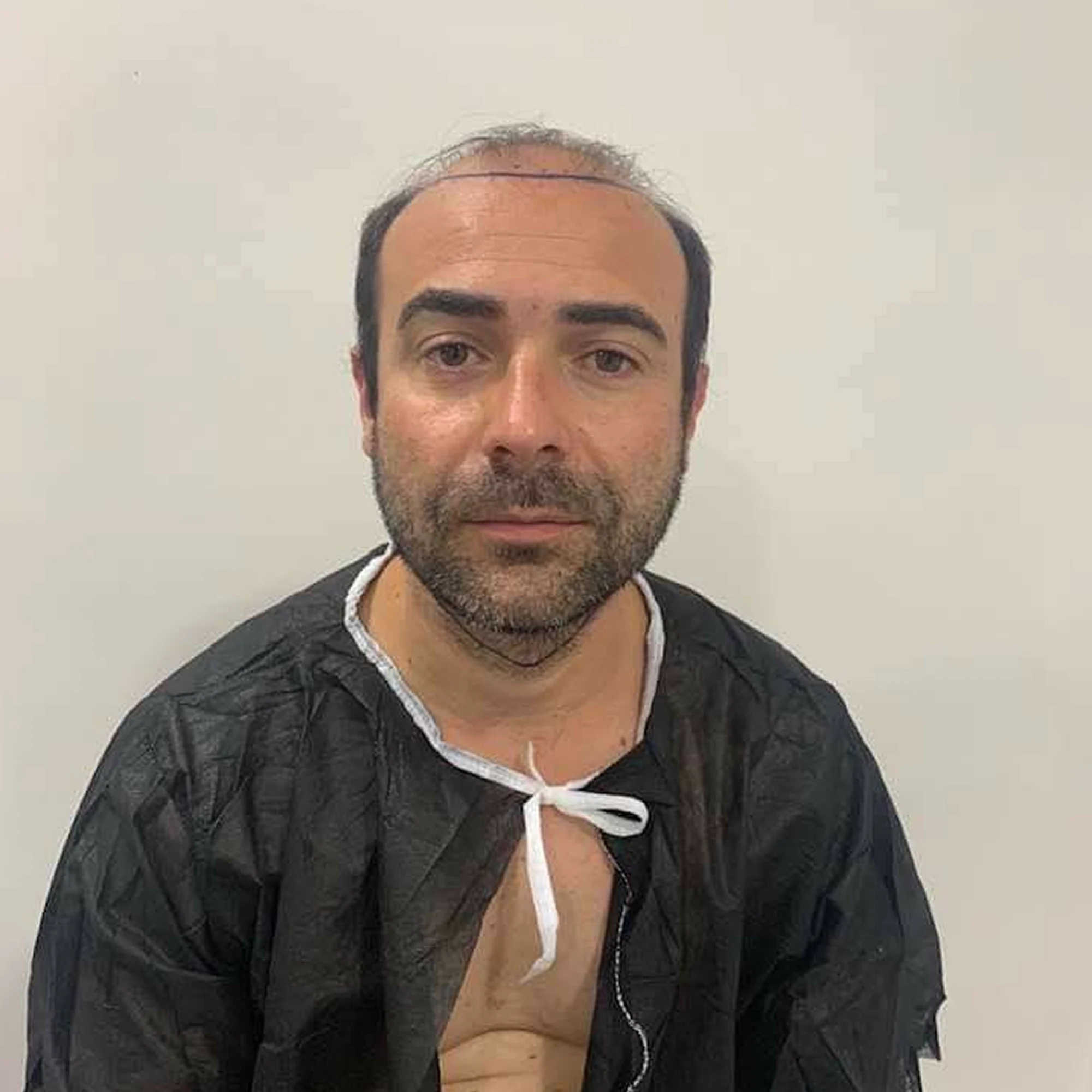 Cuoio capelluto con diradamento prima del trapianto