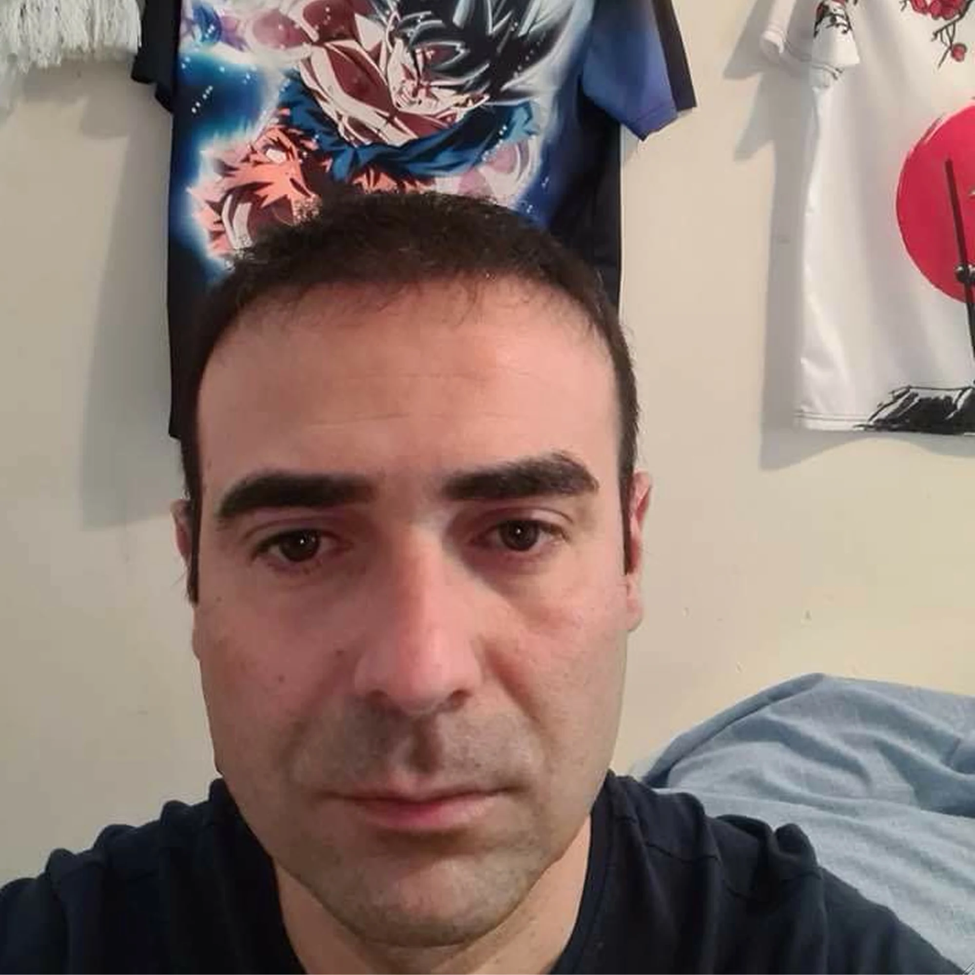 Risultato trapianto capelli con ricrescita omogenea