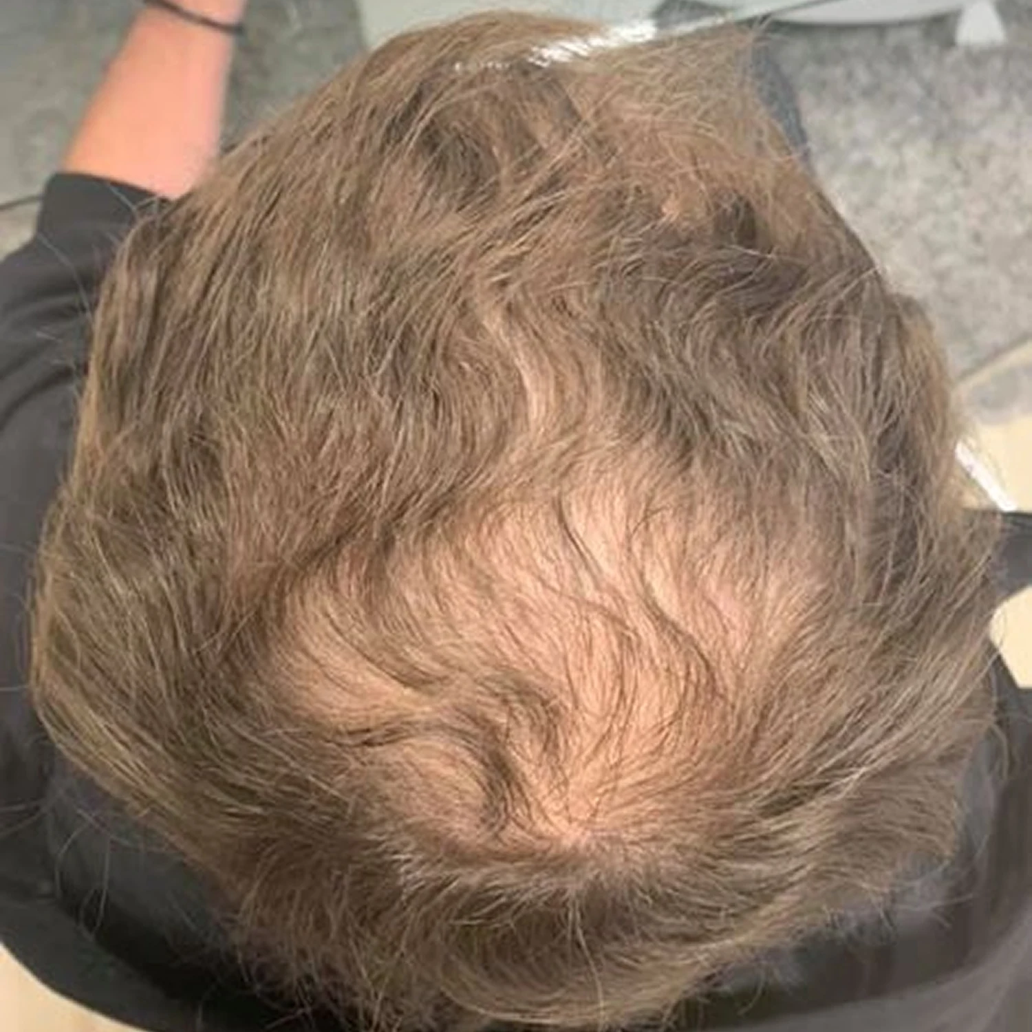 Paziente prima del trapianto capelli