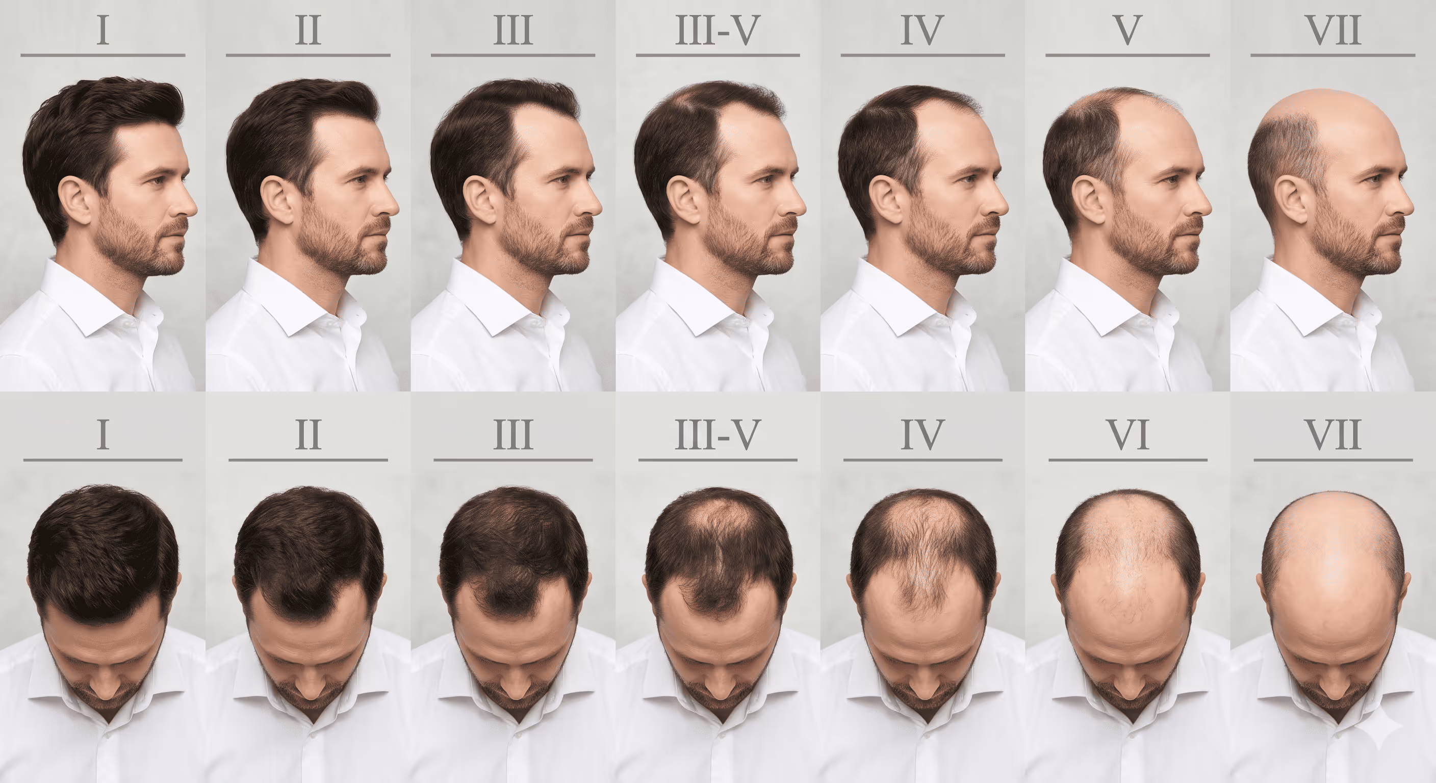 Various Stages of Alopecia