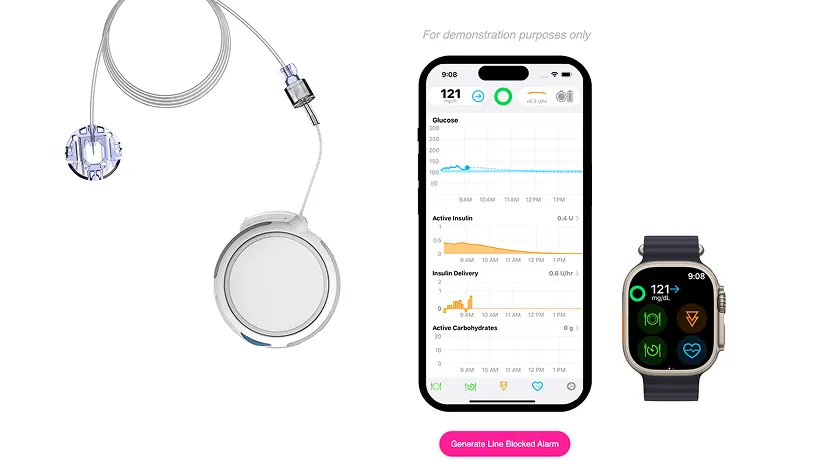 Diabetes management device with insulin pump, smartphone app showing glucose data, and smartwatch display.