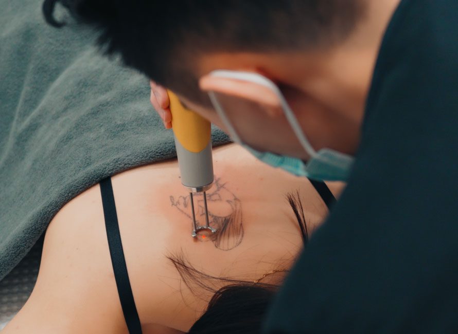 Comprehensive Guide to Laser Tattoo Removal Aftercare