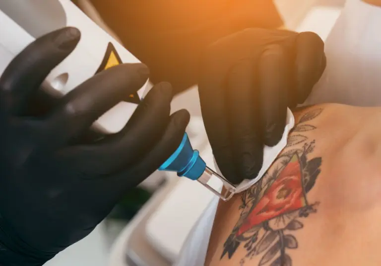 The Healing Benefits of Laser Tattoo Removal
