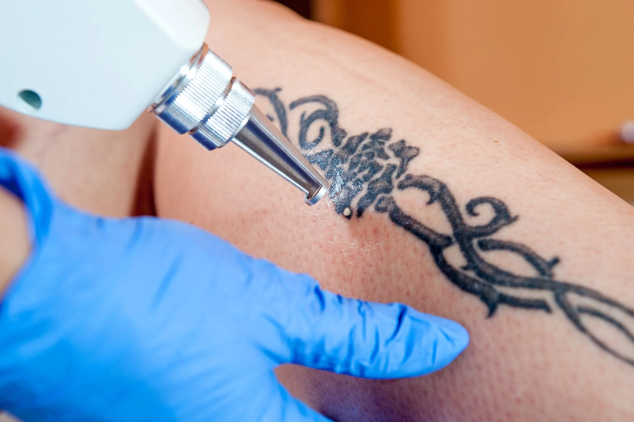 How to Prepare for Your Laser Tattoo Removal Appointment: A Comprehensive Guide
