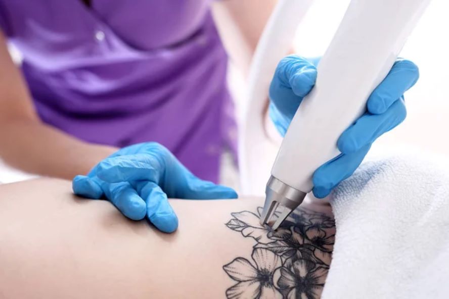 The Evolution of Laser Tattoo Removal: A Journey Through Time