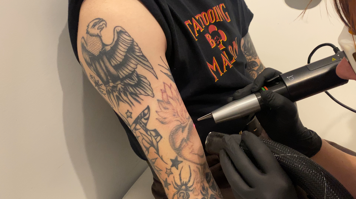 Why a Consultation Matters in Tattoo Removal