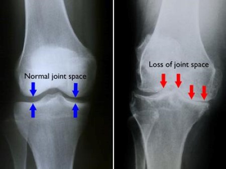 Understanding Knee Arthritis - Osteoarthritis Vs Rheumatoid Arthritis