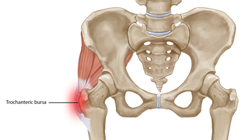 Greater Trochanter Pain Syndrome (GTPS) - Classification & Management