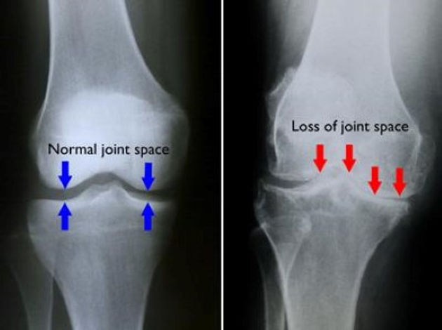 knee osteoarthritis xray