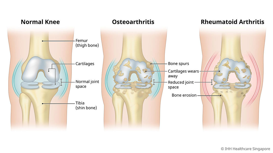 knee osteoarthritis versus rheumatoid arthritis 