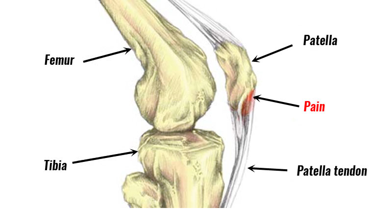 Jumpers Knee (Patella Tendinopathy) - Effective Management is Key