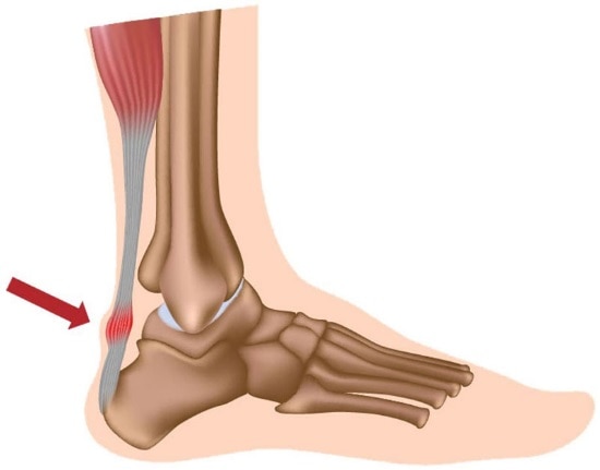 Achilles Tendinopathy - Classification & Management 